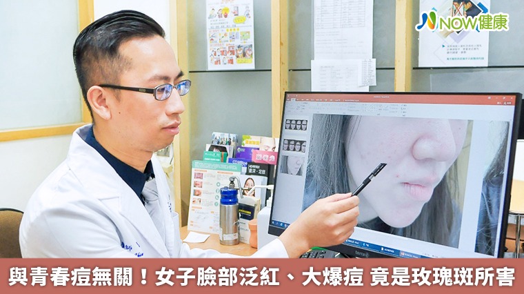 與青春痘無關！女子臉部泛紅、大爆痘　竟是玫瑰斑所害