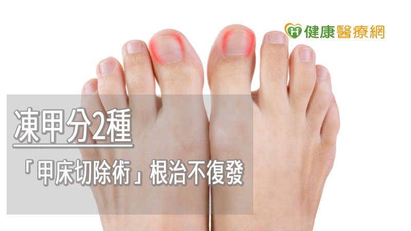 十歲男童深受「凍甲」所苦　「甲床切除術」根治不復發