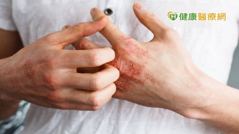 皮膚癢狂抓恐誘發「冬季濕疹」！ 醫授「日常保濕保養法」