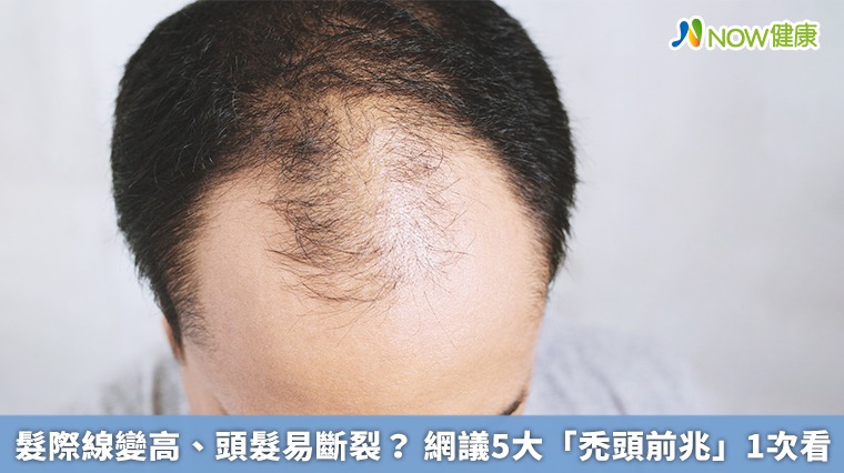 髮際線變高、頭髮易斷裂？ 網議5大「禿頭前兆」1次看