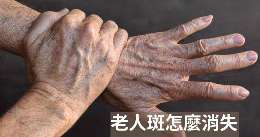 老人斑不只是老化！醫揭「全身警訊」　心臟、腦部也在變老