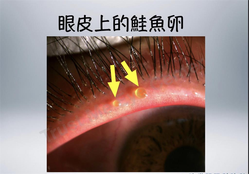 眼皮出現水泡像極「鮭魚卵」　醫師：眼瞼功能不良「後患」無窮