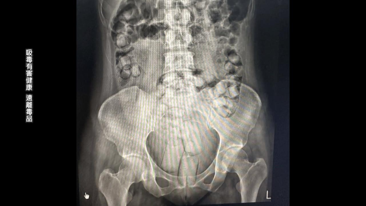 狂吞１１５顆海洛因毒品　兩泰女一落地入境就被逮