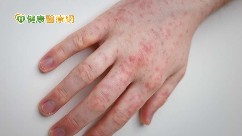 國內麻疹病例＋3！國外疫情也相當嚴峻　今年美國麻疹病例數已是去年2倍