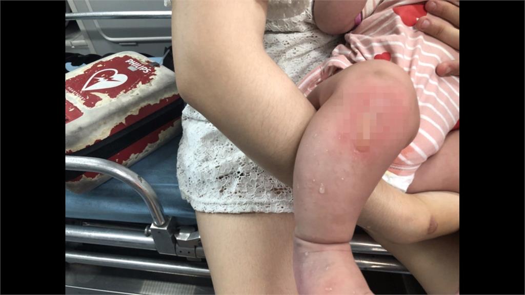 女嬰二度燙傷 母控被房客潑不明液體