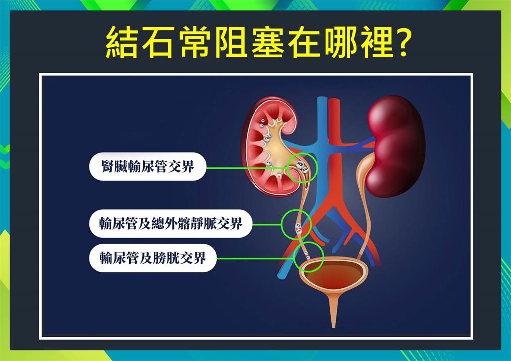 名醫妙方／男人一生的最痛！尿路結石！聽說玩「雲霄飛車」能治療？