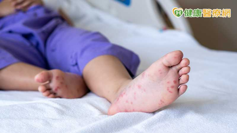 腸病毒疫情升溫！女童併發猛爆性心肌炎亡　30歲男重症住加護未脫險