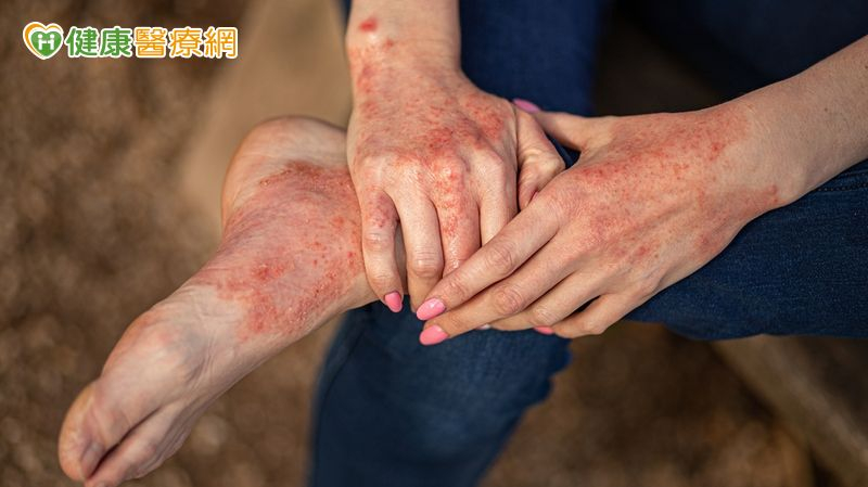 異位性皮膚炎、乾癬不只是皮膚病 反覆發炎當心影響全身健康