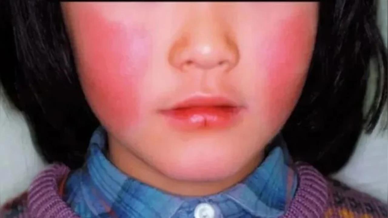 沖繩那霸市爆發「蘋果病」疫情 孕婦感染恐流產