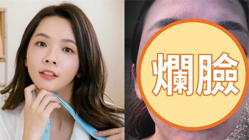滴妹飛夏威夷做「1件事」大過敏!紅疹爬滿身「近距離爛臉照」嚇壞眾人