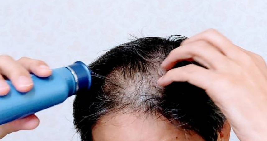 禿頭掰掰！台大團隊研發「20天生髮精華」登國際　1800萬網友關注：保護台灣