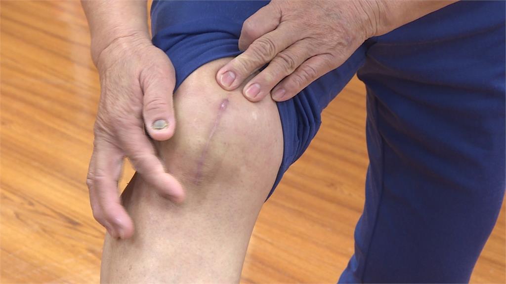 「牛津半膝關節手術」助老婦重生 雙腳變超軟Q