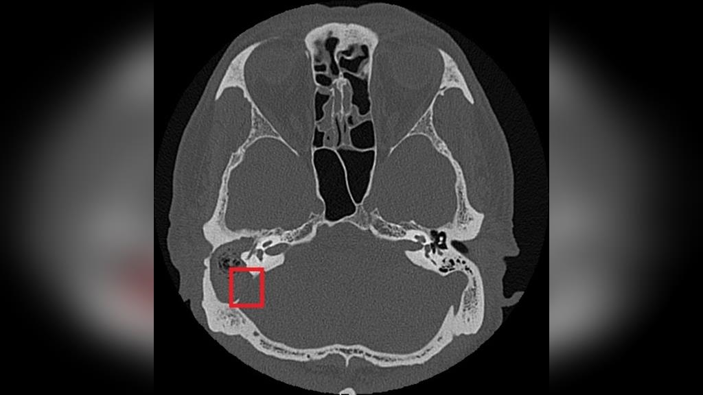慢性中耳炎勿輕忽！小心併發膽脂瘤造成聽力與神經損傷