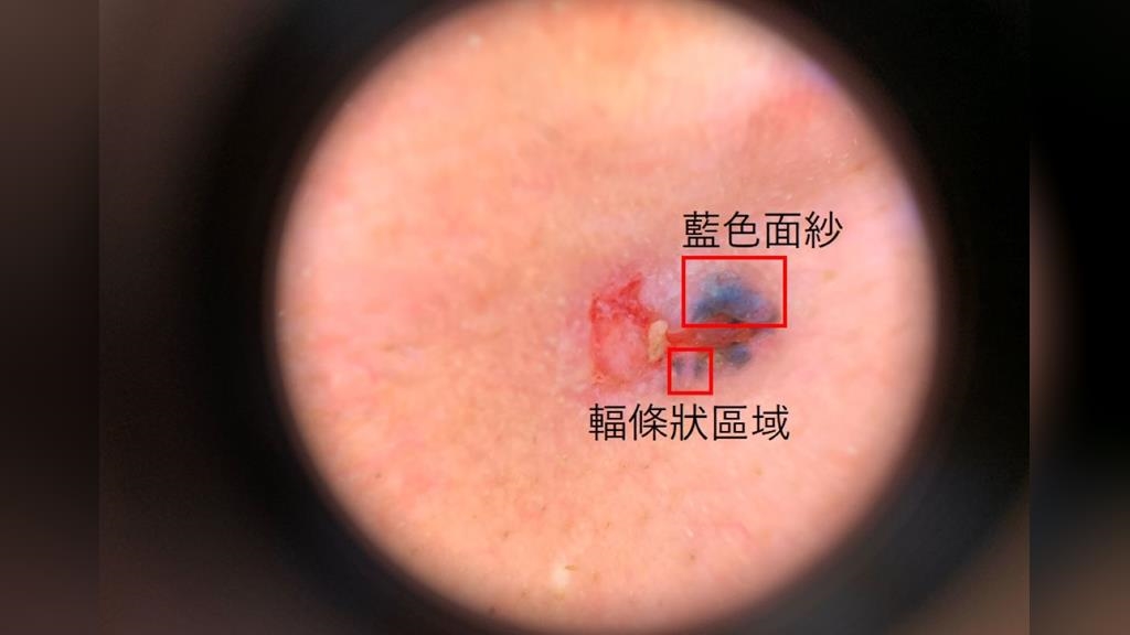 台灣每年3千6百人確診皮膚癌!小心臉上黑斑竟是「皮膚基底細胞癌」 !