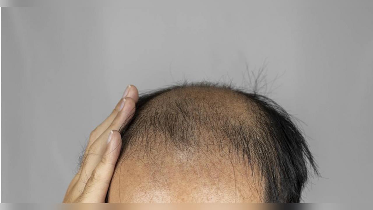 禿頭族的福音!台大研發「20天生髮神液」百萬網友激動喊:保護台灣