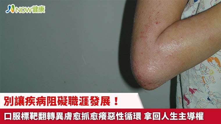 別讓疾病阻礙職涯發展！口服標靶翻轉異膚愈抓愈癢惡性循環 拿回人生主導權