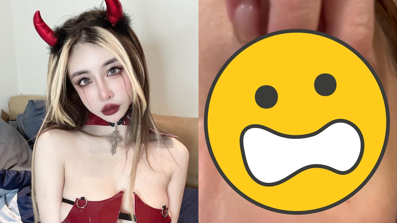 雪碧砸近千萬整形「眼睛留下後遺症」!她崩潰喊「像被針插」慘況曝光