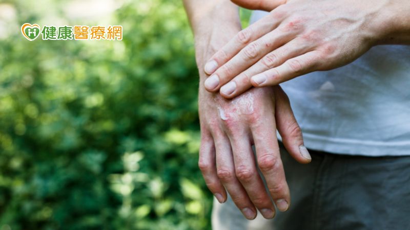 疫情期間乾癬如何控制？　生物製劑助化「癬」為夷！