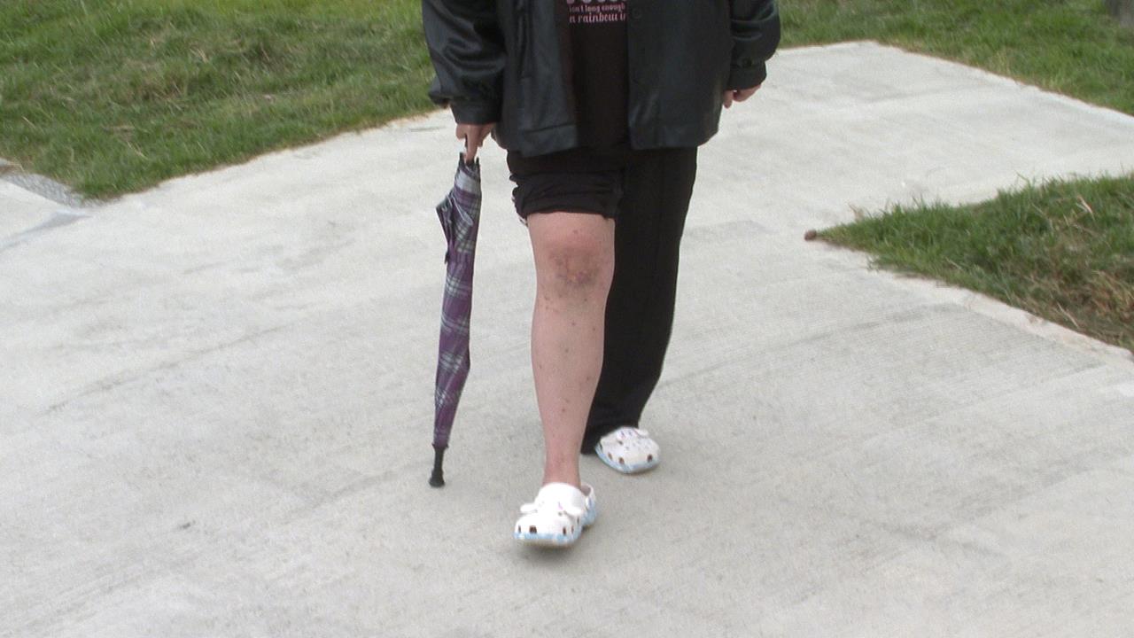 「鞋帶」捲手扶梯害摔飛 女控百貨不處理至今走路仍跛