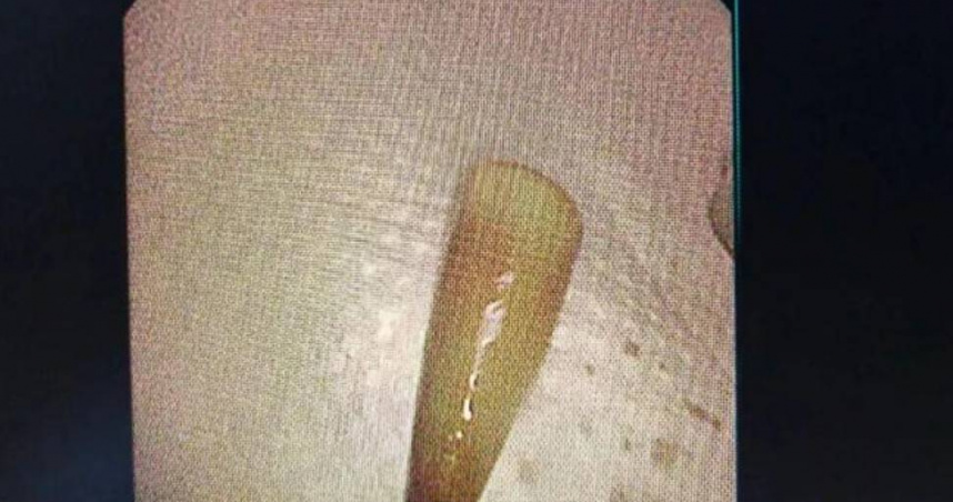 24歲男聚餐吐血送醫！醫生從肺部取出「這物」　他傻眼：小學弄丟的