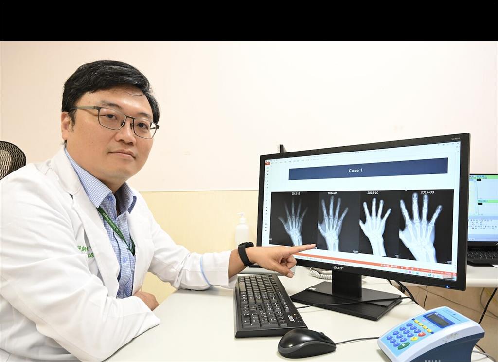 廚師患一病誤認「不會痛就沒事」  痛起來骨頭已被侵蝕！