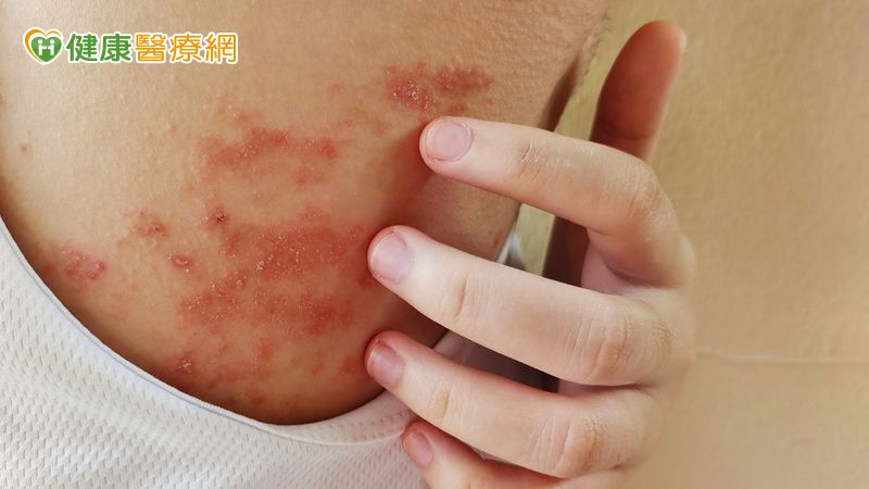 癢到睡不著、抓到流血？醫曝異位性皮膚炎3大關鍵解方