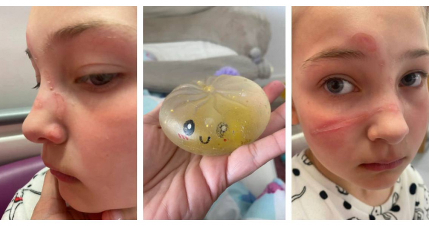 跟風TikTok微波紓壓球!10歲女童臉上炸出長傷痕 恐永久留疤