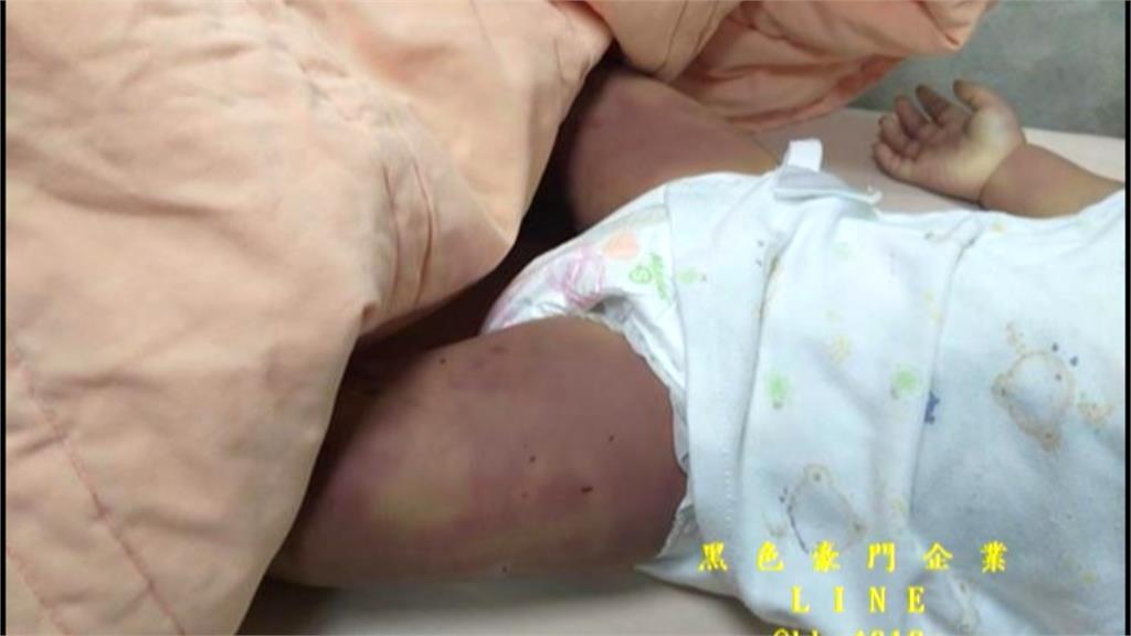 台南1歲女童疑遭生母虐死 全身刀傷菸燙