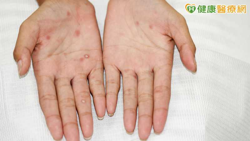 15至24歲去年梅毒確診數增近2千例　疾管署揭主因並籲善用1資源