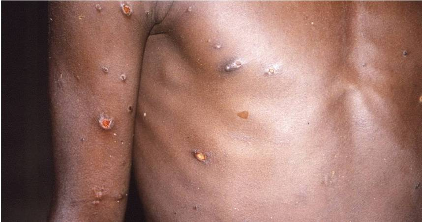 M痘疫情持續!11月新增7例「皆本國青壯男性」 全台案例分布曝光