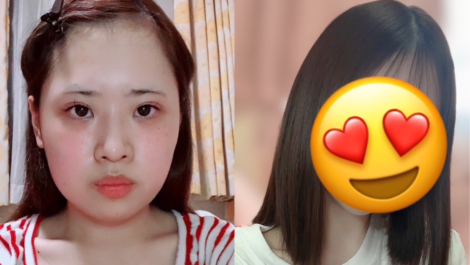 錢用在刀口上！日本妹子砸「176萬整形」對比照網驚喊：根本乃木坂成員