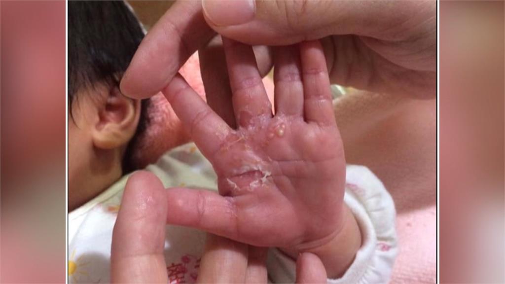 女嬰滿手膿皰破裂住院 父母控月子中心太髒