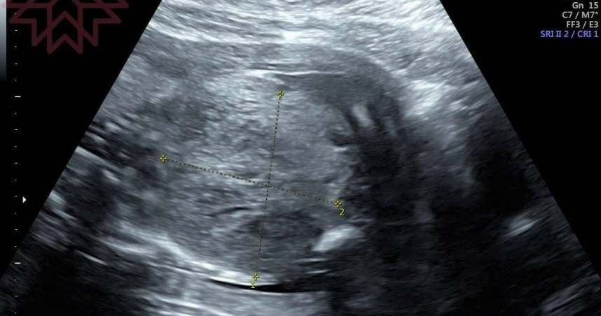 孕婦產檢發現「寶寶肚子有巨大腫瘤」醫嘆：1周後胎兒心跳停止了