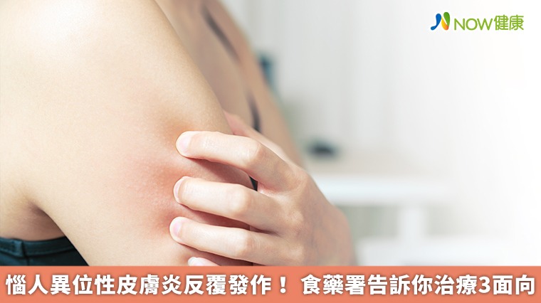 惱人異位性皮膚炎反覆發作！食藥署告訴你治療3面向