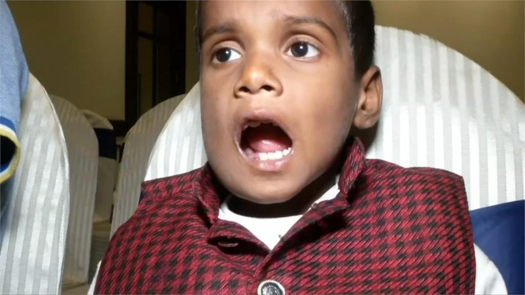 驚！印度男童患「罕見牙瘤」 長滿500多顆牙