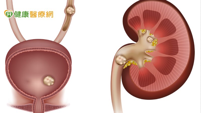 不會痛的結石最危險！　4種人對痛敏感度低恐  瀕臨洗腎