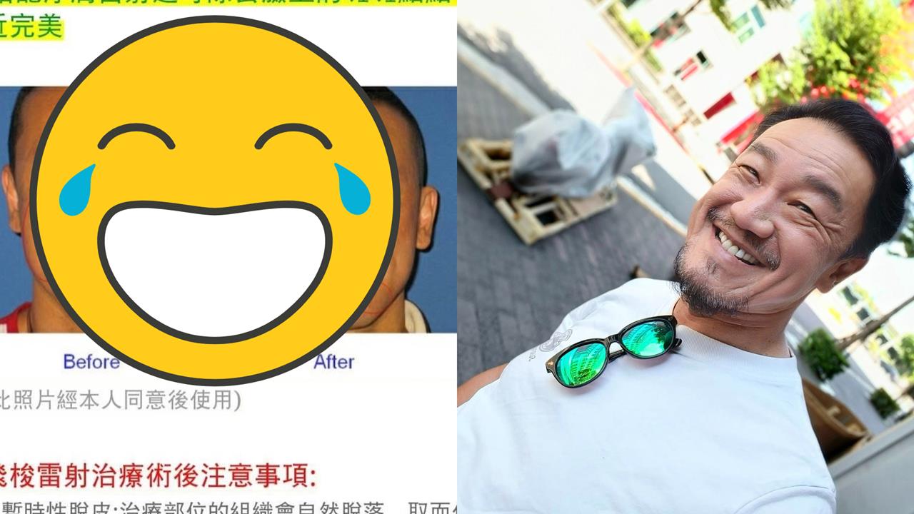 醫美模特「對比照外流」竟是陳為民！「打碼無效」秒被認出網笑：2張都before？