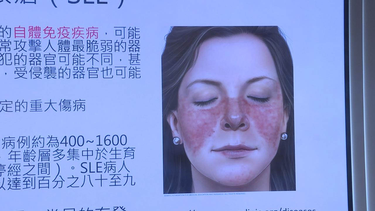 不只坣娜!港星周海媚也因罹患紅斑性狼瘡病逝