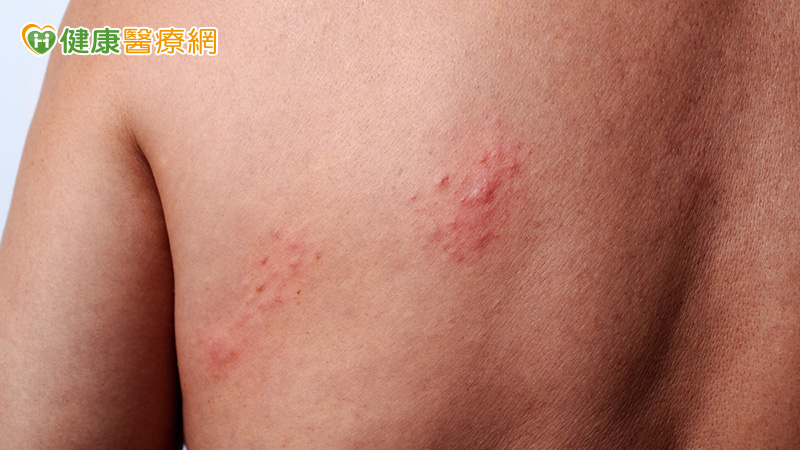 皮膚病一定能「斷根」？醫破解過敏、香港腳與帶狀皰疹常見迷思