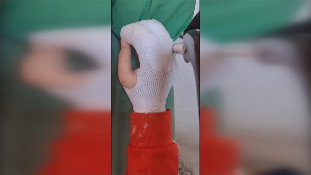 病患住院手指燙傷恐截肢 家屬控醫院虐待
