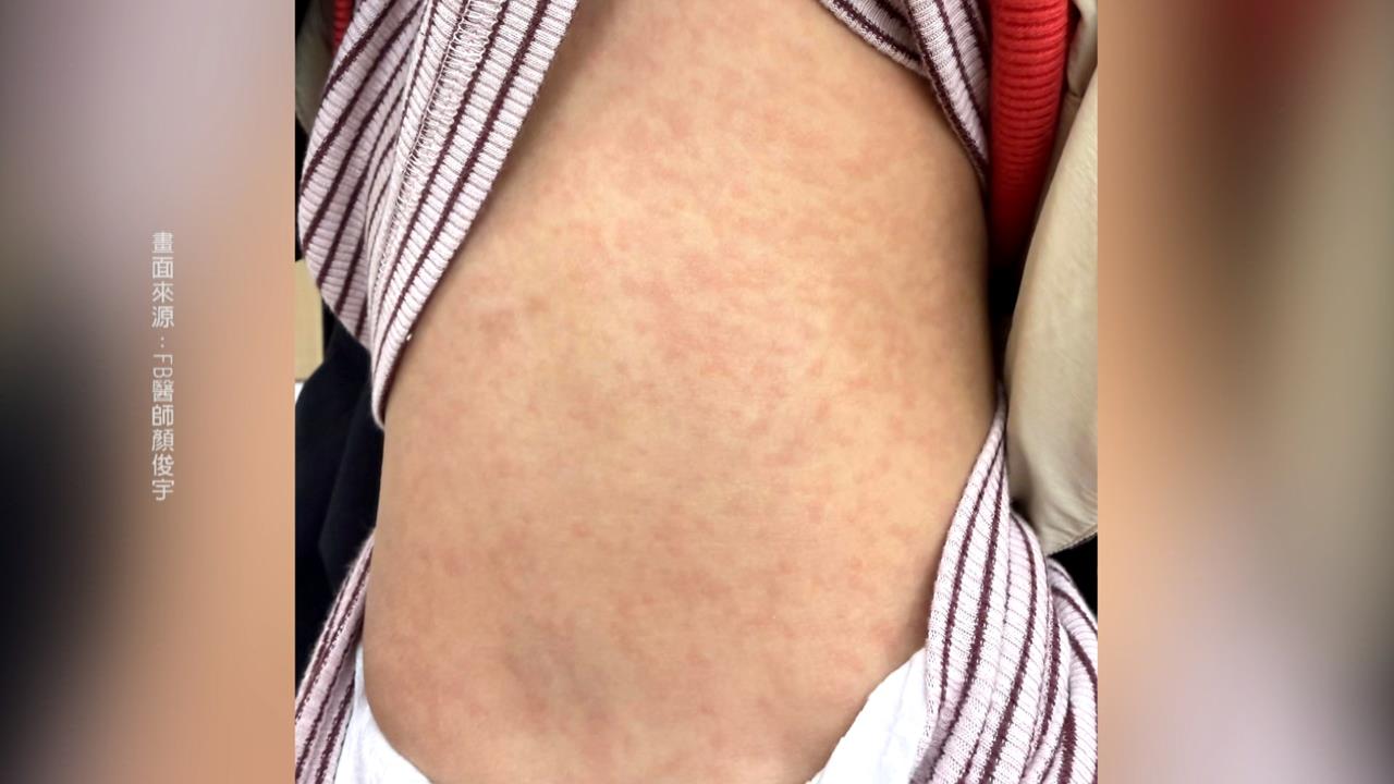 天冷小孩狂冒紅疹! 兒醫:"內刷毛"衣物釀皮膚災難
