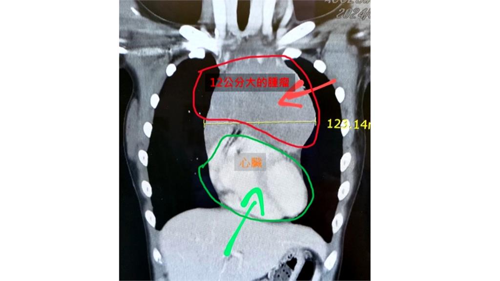 13歲少女胸悶檢查出「12公分大腫瘤」壓迫心臟　罹罕見淋巴癌