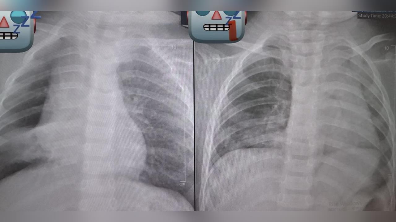 阿嬤餵孫整顆花生「卡氣管3天長肉芽」！見「肺塌陷」險喪命⋯醫師發文怒斥