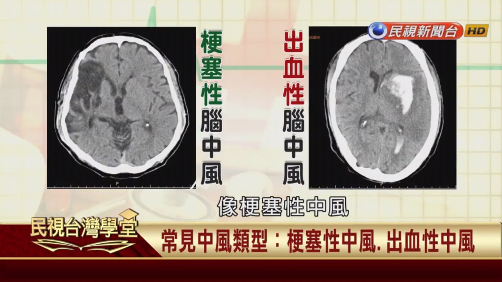有中風家族病史的別輕忽!等到眼歪嘴斜已為時已晚!