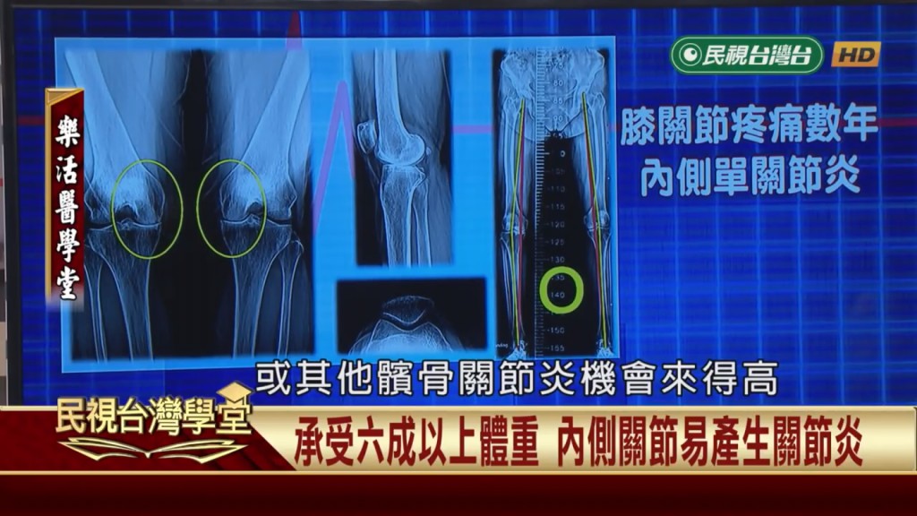走路膝蓋疼痛?關節炎不是老年人專屬!年輕人也要小心
