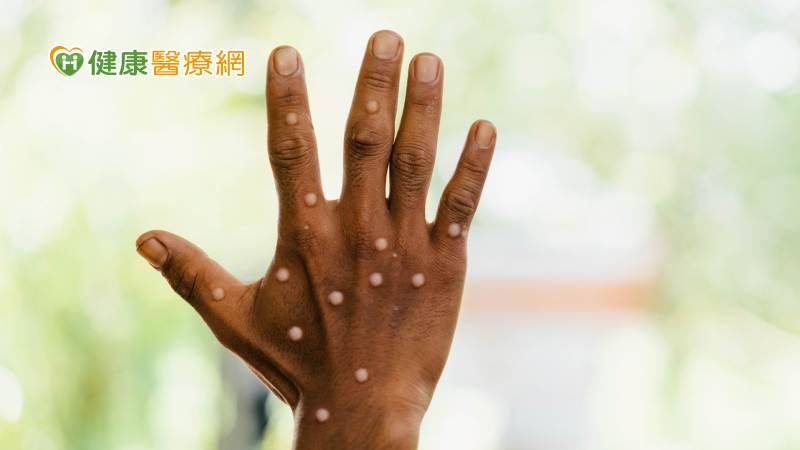 WHO決議M痘持續列為「公衛緊急事件」　並提供8項M痘臨時建議
