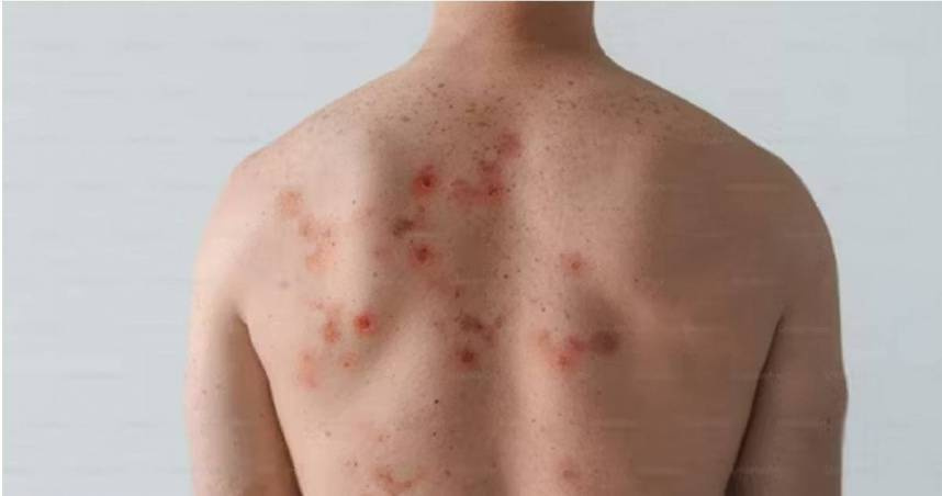 中部男赴日旅遊染麻疹！274人遭匡列　疾管署揭日本6地疫情最嚴峻