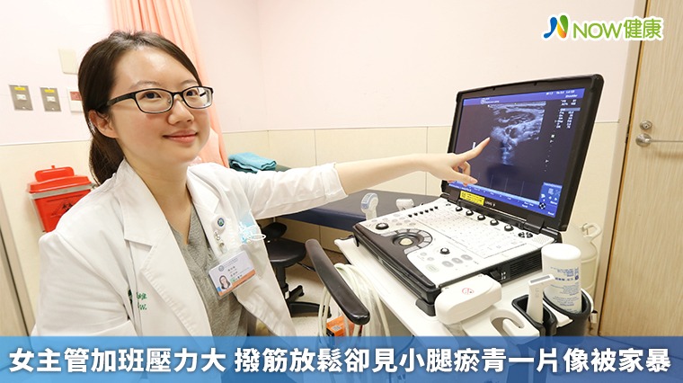 女主管加班壓力大　撥筋放鬆卻見小腿瘀青一片像被家暴