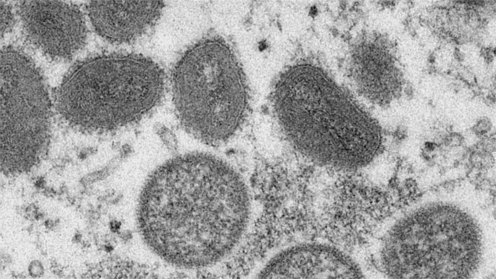 雙疫夾擊！　全球Omicron變種增3成 猴痘破6千例