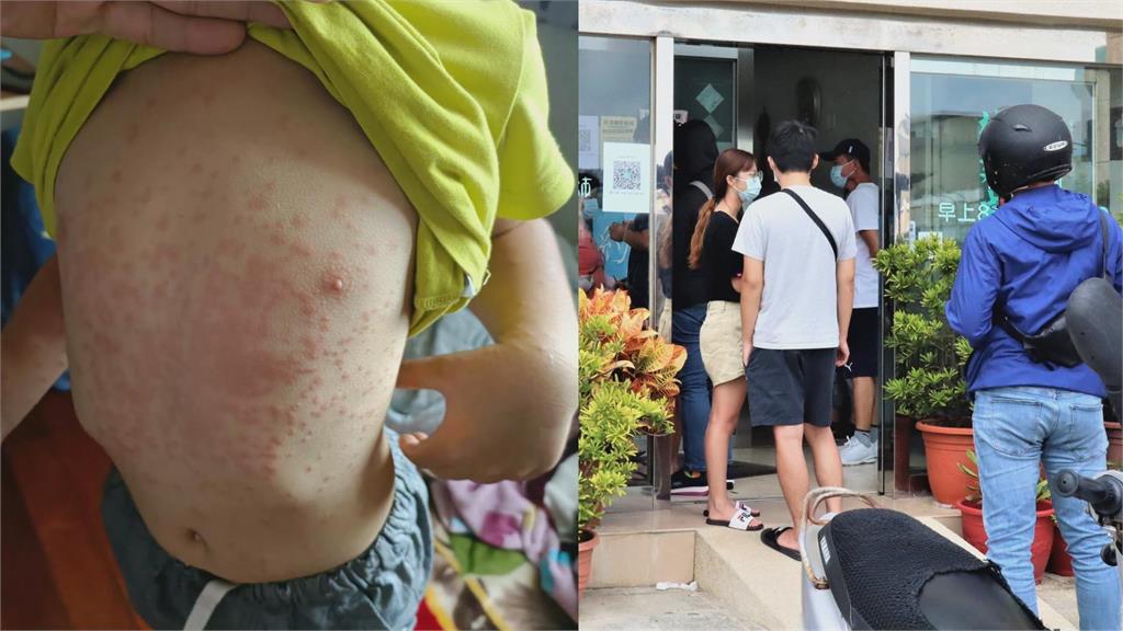 感染源不明！澎湖驚傳爆發「皮膚怪病」　上百人身體起紅疹診所大爆滿